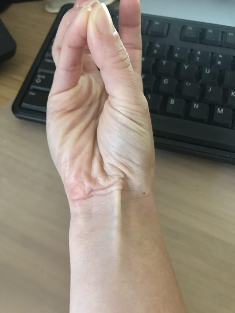 palmaris longus muscle