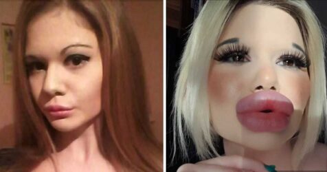 This 24-year-old girl has spent over $5,000 on lip fillers trying to break the world record for "biggest lips"